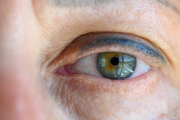 Bruise under the eyes are caused by fatigue, nervousness, lack of sleep, insomnia and stress