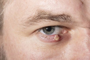 Stye-up 'ı olan bir adamın gözü. Bir adamın kirpiklerindeki saç folikülünde akut kırmızı iltihap.. 