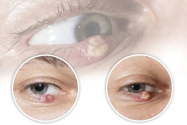 Set of the photos with Eye of a guy with stye close-up. Acute red purulent inflammation of the hair follicle of the eyelashes of a man. Treatment and prevention of eye diseases.