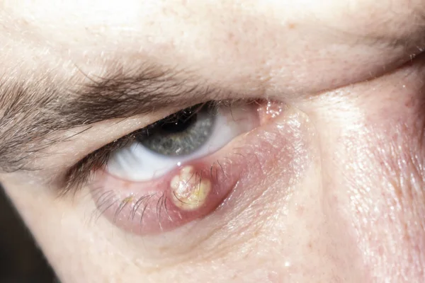 Eye of a guy with stye close-up. Acute red purulent inflammation of the hair follicle of the eyelashes of a man.