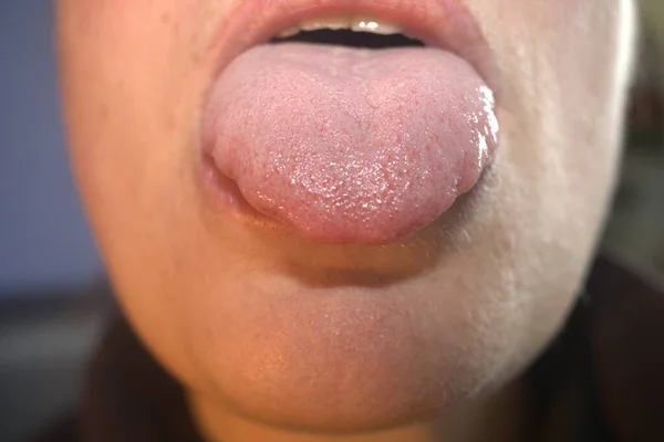 肿大的大的白色舌头 有波浪形的波纹鳞状边缘 医学名称为巨乳 并有肿块 — 图库照片