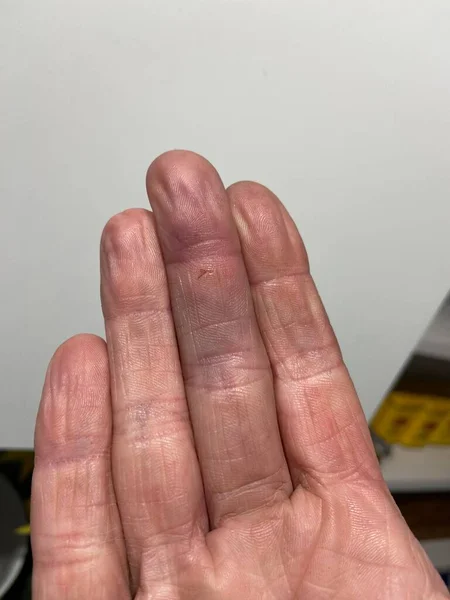 Κόκκινο Πρησμένο Κόψιμο Τραύμα Στο Χέρι Σκουριασμένο Γδάρσιμο Των Νυχιών — Φωτογραφία Αρχείου