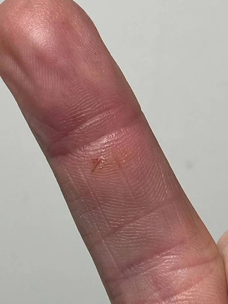 Vermelho Inchado Corte Acidente Ferida Mão Com Ferrugem Infecção Por — Fotografia de Stock