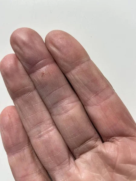 Κόκκινο Πρησμένο Κόψιμο Τραύμα Στο Χέρι Σκουριασμένο Γδάρσιμο Των Νυχιών — Φωτογραφία Αρχείου