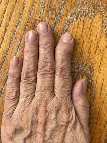 天鹅脖子上的畸形紧闭在手指头上 手掌后部 类风湿关节炎致手指畸形的例子 — 图库照片