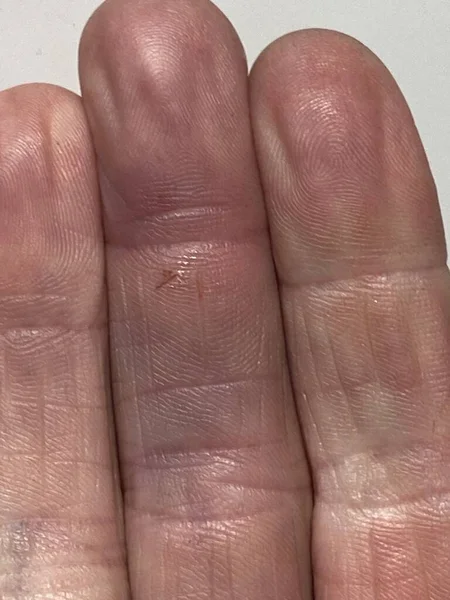 Elinde Kırmızı Şişmiş Kesik Yarası Paslı Tırnak Aşınma Enfeksiyonu Tetanos — Stok fotoğraf