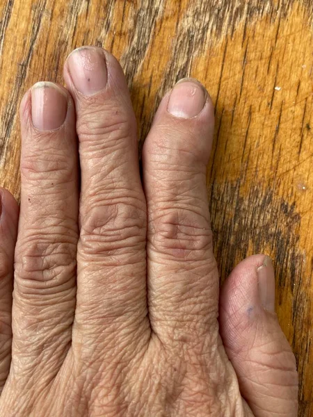 天鹅脖子上的畸形紧闭在手指头上 手掌后部 类风湿关节炎致手指畸形的例子 — 图库照片