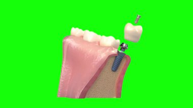 3 boyutlu diş implantı.