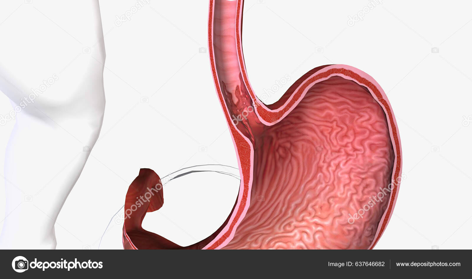Barretts Esophagus Condition Which Tissue Lining Esophagus Replaced