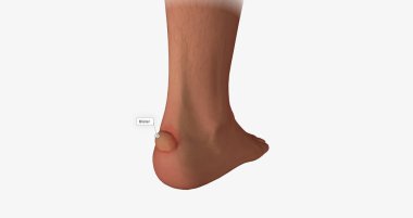 Blisters often form on the heels of the feet and inner gripping surfaces of the hands. 3D rendering