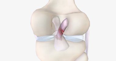 A tear in the anterior cruciate ligament is one of the most common knee injuries. 3D rendering