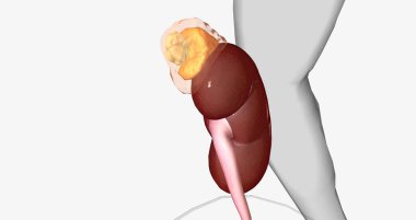 An adrenal incidentaloma is a solid mass in one or both adrenal glands. 3D rendering