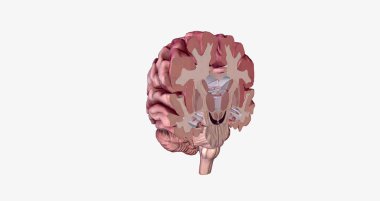 Alzheimer's Disease Brain Cross Section 3D rendering