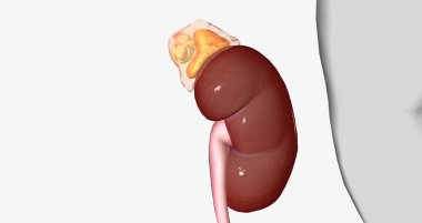 An adrenal incidentaloma is a solid mass in one or both adrenal glands. 3D rendering