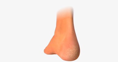 A callus is an area of thickened, hardened skin that develops as a result of frequent rubbing or repetitive motion.3D rendering