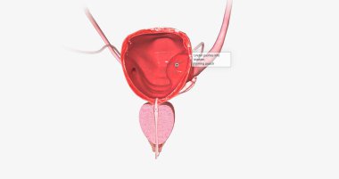 A ureterocele is a congenital defect of the ureter, the tube that carries urine from the kidney to the urinary bladder. 3D rendering