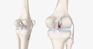 A tear in the anterior cruciate ligament is one of the most common knee injuries. 3D rendering
