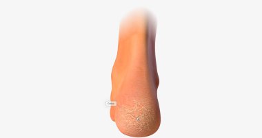 A callus is an area of thickened, hardened skin that develops as a result of frequent rubbing or repetitive motion.3D rendering
