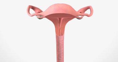 In stage I, the cancer is very small and confined to the cervix 3D rendering