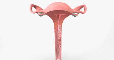 In stage III, the cancer has moved to the lower part of the vagina 3D rendering