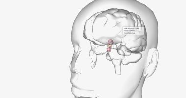 High volume of CRH released from hypothalamus 3D rendering