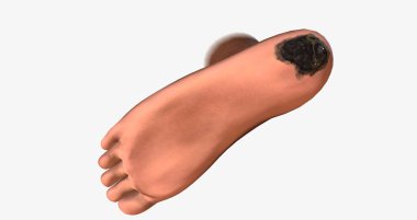 Acral Lentiginous Melanoma (ALM) on The Body 3D rendering