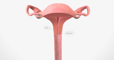 In stage I, the cancer is very small and confined to the cervix 3D rendering