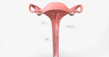 In stage III, the cancer has moved to the lower part of the vagina 3D rendering
