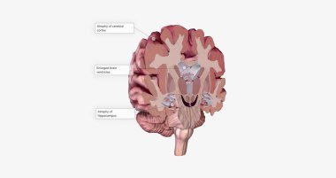 Alzheimer's Disease Brain Cross Section 3D rendering