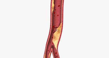 Atherosclerosis is a cardiovascular disease characterized by the gradual buildup of plaque in artery walls. 3D rendering