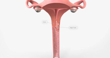 In stage II, the cancer has invaded the upper part of the vagina and tissue near the uterus called the parametrium.3D rendering