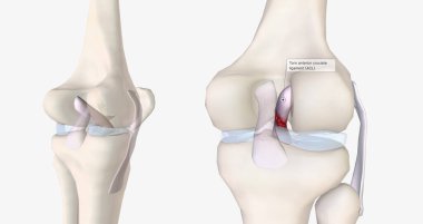 A tear in the anterior cruciate ligament is one of the most common knee injuries. 3D rendering