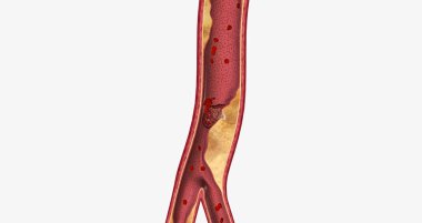 Atherosclerosis is a cardiovascular disease characterized by the gradual buildup of plaque in artery walls. 3D rendering