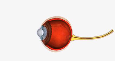 Keratoconus is an eye disease that affects the structure of the cornea. 3D rendering
