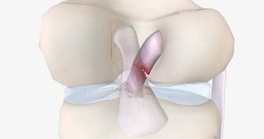 A tear in the anterior cruciate ligament is one of the most common knee injuries. 3D rendering