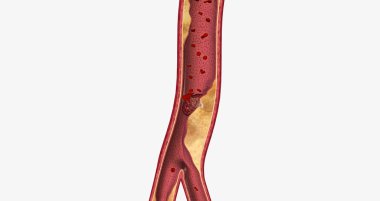 Atherosclerosis is a cardiovascular disease characterized by the gradual buildup of plaque in artery walls. 3D rendering