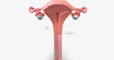 In stage I, the cancer is very small and confined to the cervix 3D rendering
