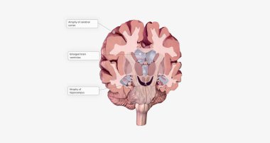 Alzheimer's Disease Brain Cross Section 3D rendering