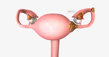 Stage II ovarian tumor has spread to nearby organs, such as the uterus and the body of the fallopian tubes. 3D rendering