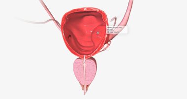 A ureterocele is a congenital defect of the ureter, the tube that carries urine from the kidney to the urinary bladder. 3D rendering