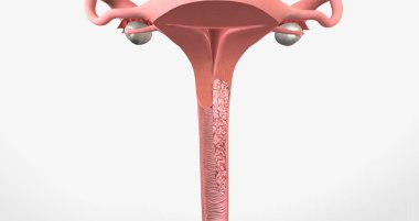 In stage III, the cancer has moved to the lower part of the vagina 3D rendering