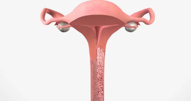 In stage III, the cancer has moved to the lower part of the vagina 3D rendering