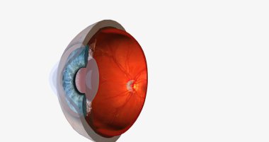 Keratoconus is an eye disease that affects the structure of the cornea. 3D rendering