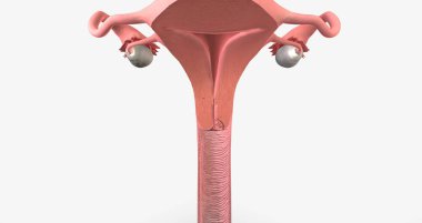 In stage I, the cancer is very small and confined to the cervix 3D rendering