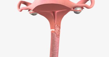 In stage II, the cancer has invaded the upper part of the vagina and tissue near the uterus called the parametrium.3D rendering