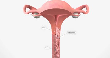 In stage III, the cancer has moved to the lower part of the vagina 3D rendering