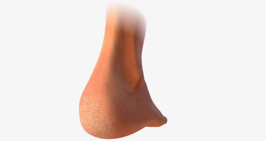 A callus is an area of thickened, hardened skin that develops as a result of frequent rubbing or repetitive motion.3D rendering