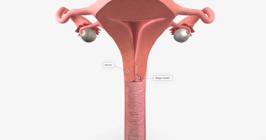 In stage I, the cancer is very small and confined to the cervix 3D rendering