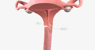 In stage II, the cancer has invaded the upper part of the vagina and tissue near the uterus called the parametrium.3D rendering