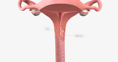 In stage II, the cancer has invaded the upper part of the vagina and tissue near the uterus called the parametrium.3D rendering